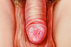 Кандидозный баланопостит Кандидозный баланопостит