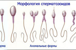 Морфология сперматозоидов при бесплодии у мужчин Морфология сперматозоидов при бесплодии у мужчин