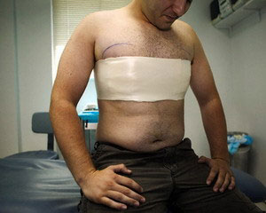 Операция при гинекомастии Операция при гинекомастии