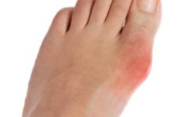 Нарост на ноге Нарост на ноге