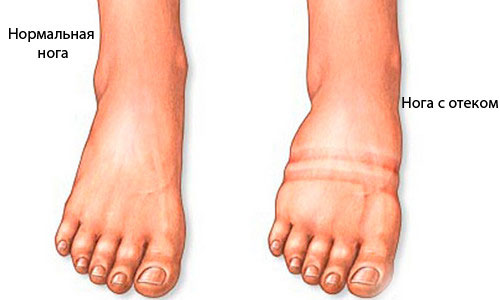 Отеки ног Отеки ног