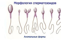Аномальные формы сперматозоидов Аномальные формы сперматозоидов