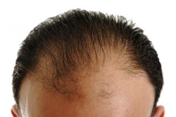 Сильная потеря волос Сильная потеря волос