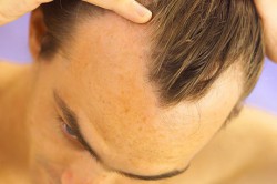 Залысины на лбу у мужчины Залысины на лбу у мужчины