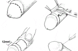 Обрезание по круговому иссечению Обрезание по круговому иссечению
