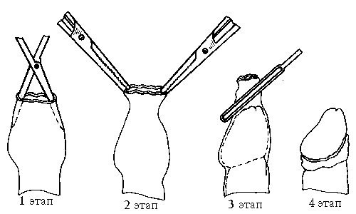 Циркумцизия - процедура обрезания крайней плоти Циркумцизия - процедура обрезания крайней плоти
