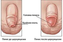 Циркумцизия - обрезание крайней плоти Циркумцизия - обрезание крайней плоти
