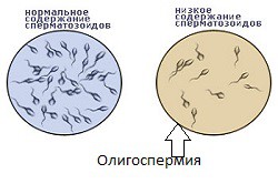 Олигоспермия Олигоспермия
