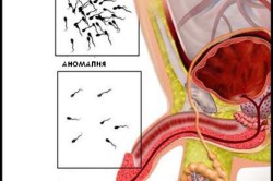 Уменьшение сперматозоидов Уменьшение сперматозоидов