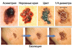 Опасные родинки Опасные родинки