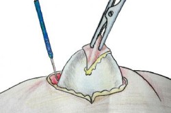 Операция Операция