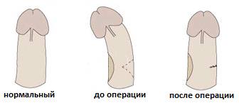 До и после операции До и после операции