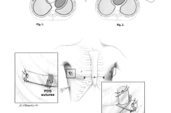 Лечение методом Насса Лечение методом Насса