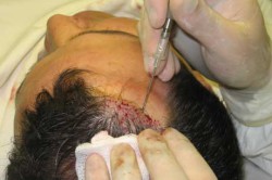 Операция по выпрямлению полового члена Операция по выпрямлению полового члена