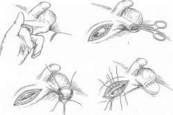 Операция орхипексия