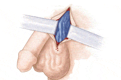 Операция по удалению варикоцеле Операция по удалению варикоцеле