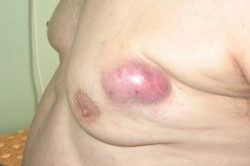 Типовое расположение опухоли в мочевом пузыре Типовое расположение опухоли в мочевом пузыре