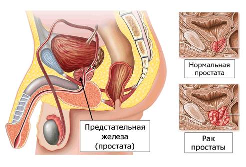 Болезнь и норма предстательной железы Болезнь и норма предстательной железы