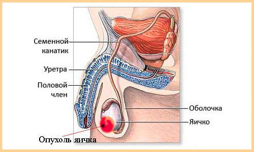Опухоль яичка Опухоль яичка