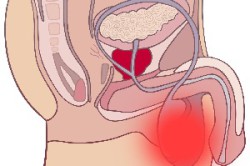 Орхит яичка Орхит яичка