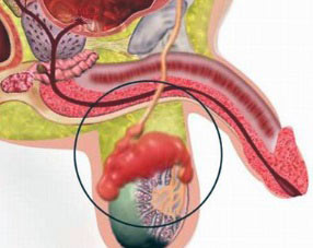 Орхит при воспалении яичка Орхит при воспалении яичка