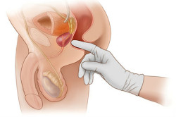 Пальцевой осмотр прямой кишки osmotr