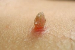 Остроконечная кондилома на кожном покрове