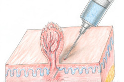 Радиоволновой скальпель для иссечения кондилом Радиоволновой скальпель для иссечения кондилом