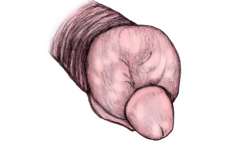 Отек полового члена Отек полового члена