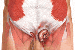 Паховая грыжа