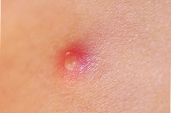 Высыпания красного цвета Высыпания красного цвета