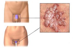 Вирус папилломы человека Вирус папилломы человека