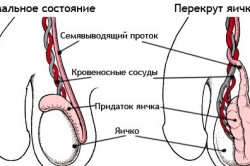 Перекрут яичка Перекрут яичка