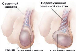 Сильная боль при перекруте яичка Сильная боль при перекруте яичка