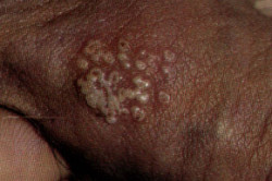 Лишай на половых органах у мужчин Лишай на половых органах у мужчин