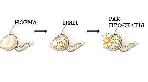 Простатическая интраэпителиальная неоплазия (ПИН) Простатическая интраэпителиальная неоплазия (ПИН)