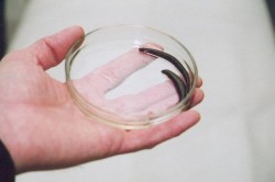 Гирудотерапия Гирудотерапия