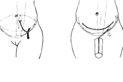 Схема неофаллопластики TRAM-лоскутом Схема неофаллопластики TRAM-лоскутом