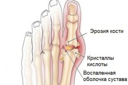 Схема подагры на ногах Схема подагры на ногах