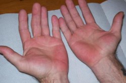 Покраснение ладоней