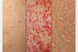 Виды потницы