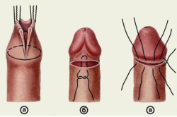 Операция обрезания