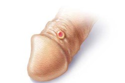 Твердый шанкр - первичный признак сифилиса Твердый шанкр - первичный признак сифилиса