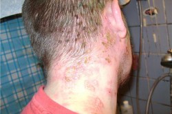 Признаки вич у мужчин Признаки вич у мужчин