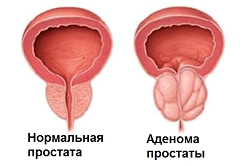 Аденома простаты Аденома простаты