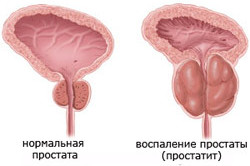 Воспаление простаты Воспаление простаты