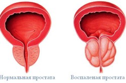 Нормальная и воспаленная простата Нормальная и воспаленная простата