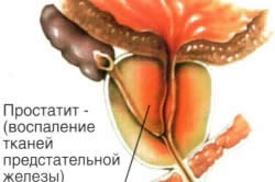 Воспаление тканей предстательной железы Воспаление тканей предстательной железы