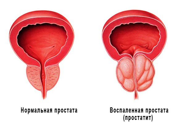 Нормальная и воспаленная простата Нормальная и воспаленная простата