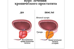 До и после лечения До и после лечения